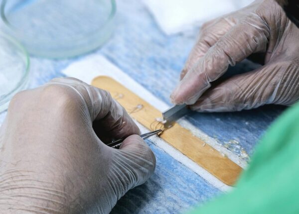 Hatalı Saç Ekimi Nedeniyle Tazminat Davası