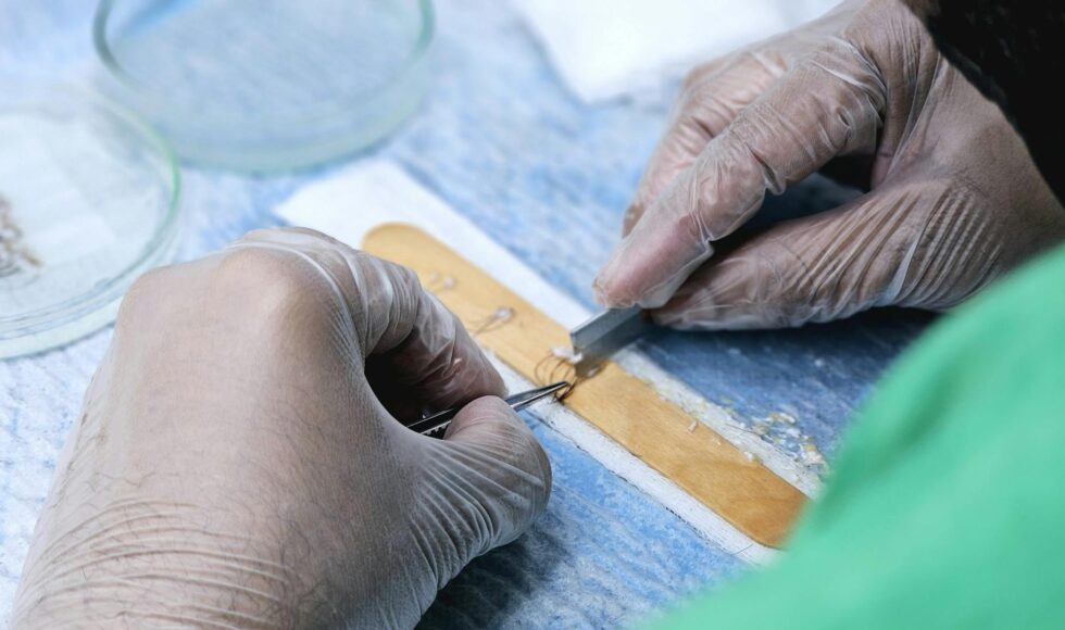 Hatalı Saç Ekimi Nedeniyle Tazminat Davası